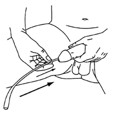 self-intermittent-catheterization